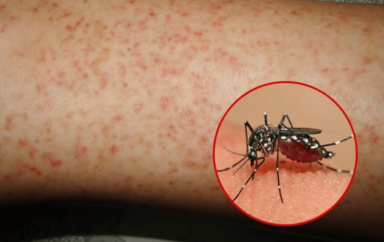 Biểu hiện dễ nhận thấy nhất khi bị sốt xuất huyết là da có dấu hiệu mẩn đỏ